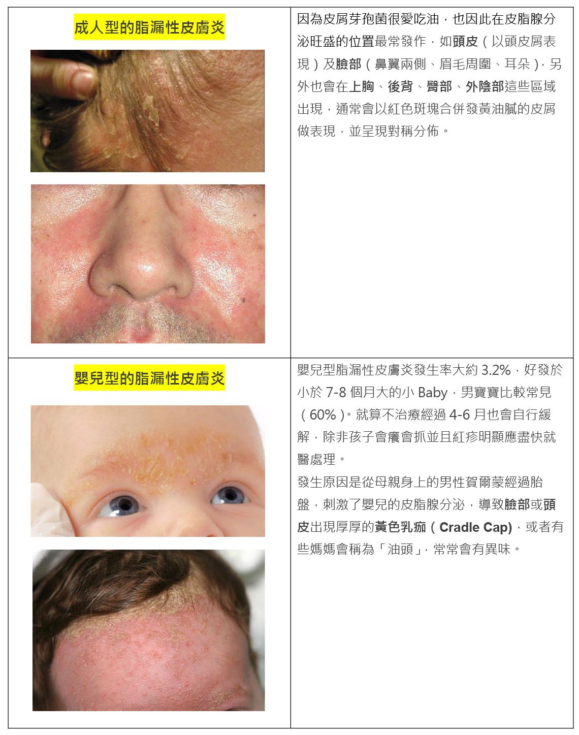 嬰兒與成人的脂漏性皮膚炎