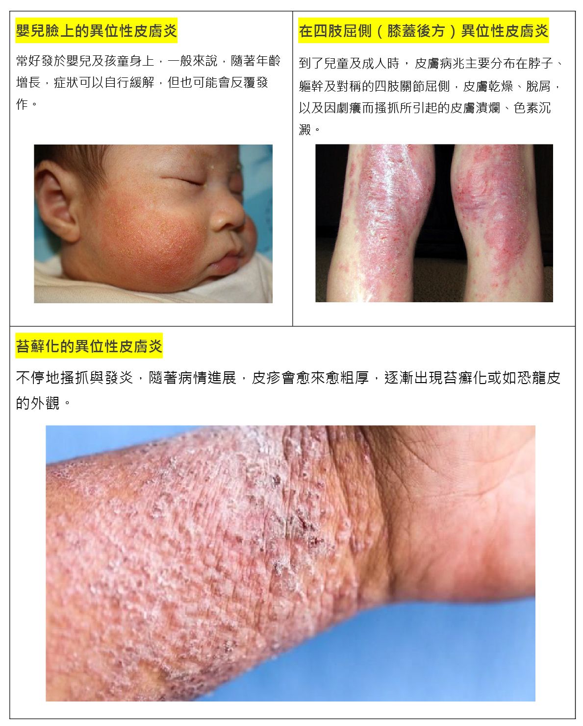 異位性皮膚炎常有症狀