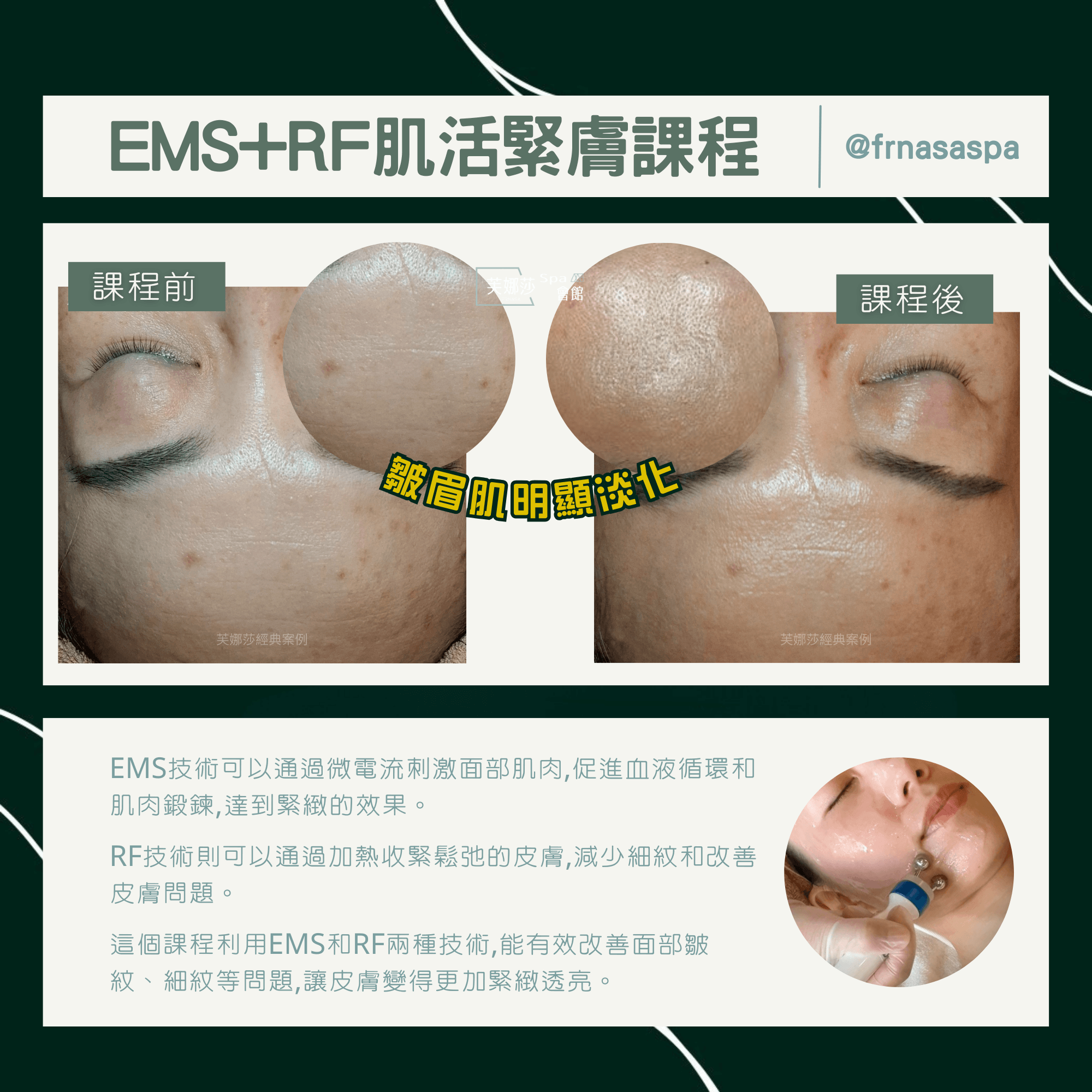 6-3案例比對-EMS+RF02.png